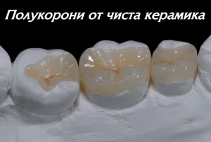 Полукорони (овърлеи) от чиста керамика
