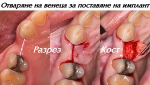 Малък разрез във венеца за достигане до костта