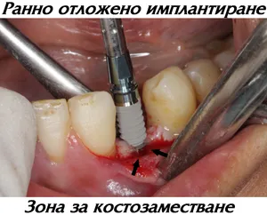 Добавяне на костозаместител около импланта при ранно отложено имплантиране