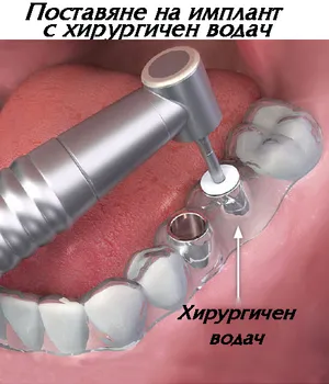 Поставяне на имплант с хирургичен водач