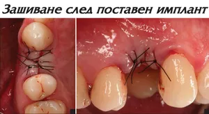Зашиване на венеца след поставяне на импланта