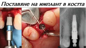 Завиване на импланта в подготвеното място в костта