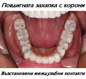 Повдигане на захапката с корони