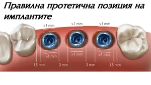 Правилна позиция на импланта в костта според мястото на бъдещия зъб