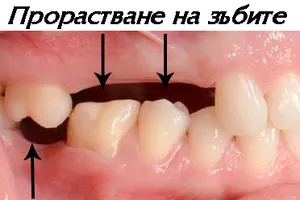 Мост върху наклонени носещи зъби
