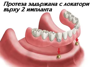 Снемаема протеза върху два импланта с локатори
