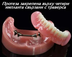 Снемаема протеза, закрепена върху импланти със шина