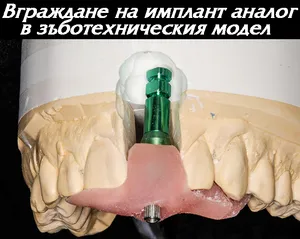 Имплантен аналог в гипсов модел на челюстта