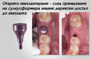 Протезиране върху зъбни импланти