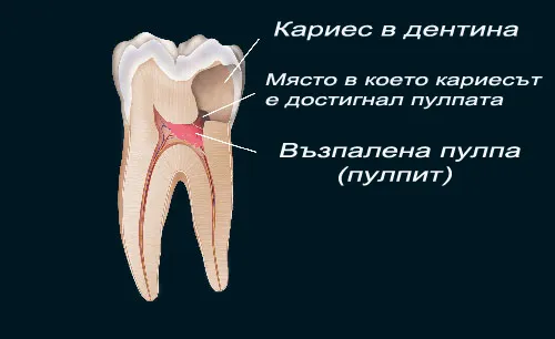 Пулпит, развил се в резултат на нелекуван кариес
