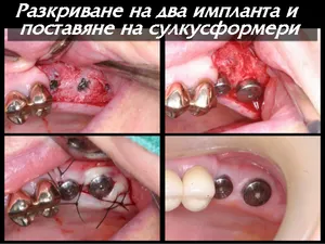 Разкриване на имплант — отваряне на венеца над поставения имплант