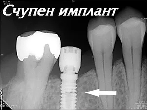 Счупен имплант