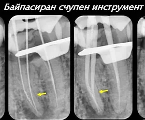 Байпасиране на счупен инструмент в коренов канал
