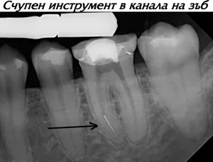 Счупен инструмент, останал в кореновия канал на зъб