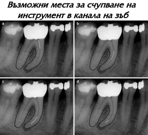 Счупен инструмент в коренови канали на зъб