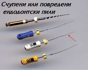 Счупен ендодонтски инструмент в корен на зъб