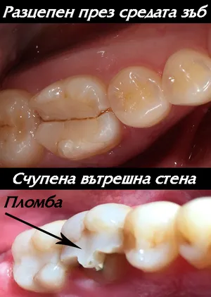 Разцепен зъб под действие на дъвкателните сили