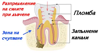Счупен умъртвен зъб с голяма пломба