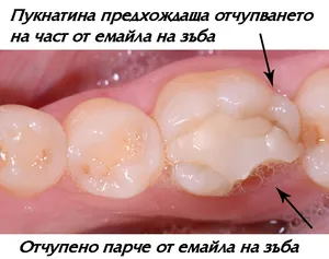 Счупване на умъртвен зъб