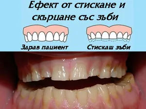 Шина против нощно стискане и скърцане на зъбите
