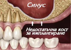 Синуслифт в горната челюст — костозаместване под синуса