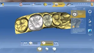 3D дизайн на корона в софтуера на CEREC