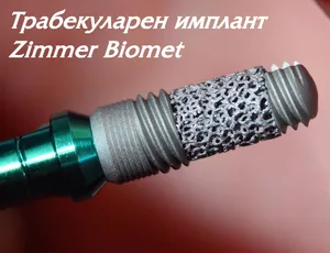 Трабекуларен имплант Zimmer с порьозна танталова част