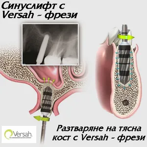 Versah фреза при повдигане на дъното на синуса