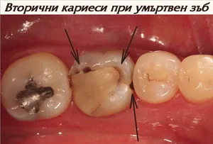 Вторичен кариес под пломба на умъртвен зъб