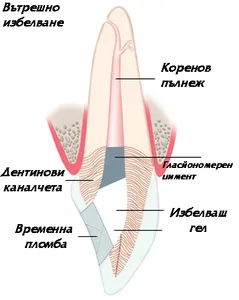 Схема на вътрешно избелване на зъб