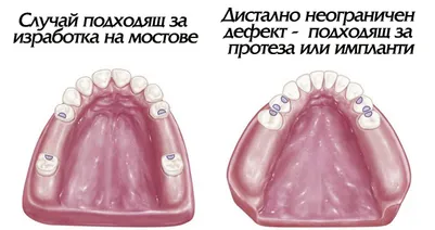 Дистално неограничен дефект в зъбната редица