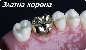 Златна зъбна корона