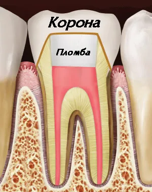 Зъб с керамична корона