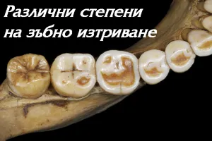 Степени на изтриване на зъбите
