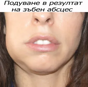 Зъбен абсцес с подуване на лицето