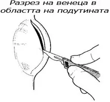 Абсцес в областта на причинния зъб