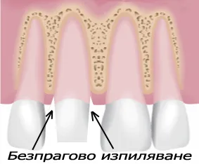Безпрагово изпиляване на зъб