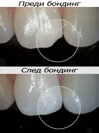 Преден зъб преди и след бондинг