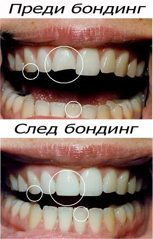 Резултат от бондинг на предни зъби