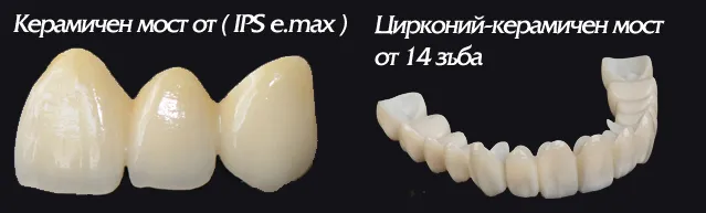 Циркониев и керамичен мост