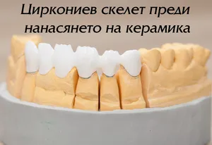 Циркониев скелет на мост