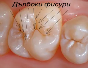 Дълбоки фисури по дъвкателната повърхност на детски зъб