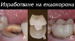 Керамична ендокорона, залепена във вътрешността на зъба