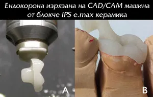 Ендокорона от чиста керамика