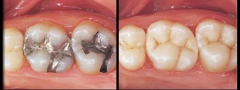 Амалгамени пломби, заменени с фотополимерни – преди и след