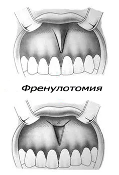 Френулотомия — удължаване на късия френулум