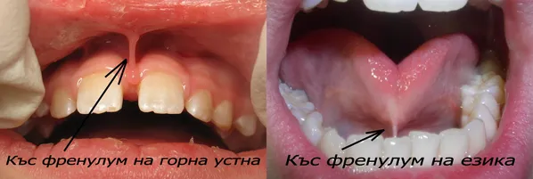 Френулуми на устните и езика