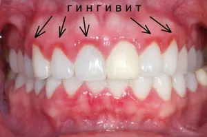 Гирляндообразно зачервяване на венеца на границата със зъбите
