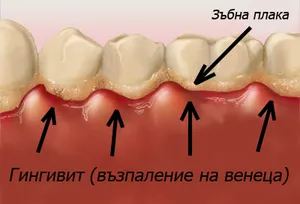 Възпален венец при гингивит