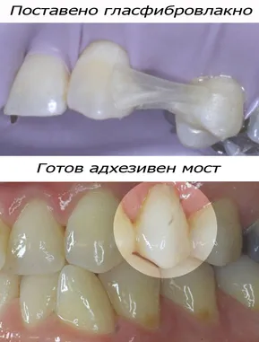 Адхезивен мост от гласфибровлакно на мястото на липсващ зъб